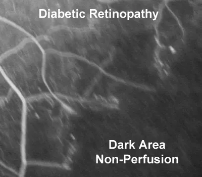 Can Diabetic Retinopathy Be Prevented?