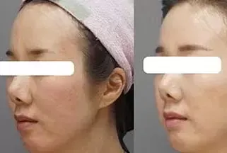 Stem Cell Facial Treatment Before And After