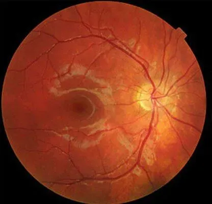 Understanding Retinal Diseases and When to Consult a Specialist in Mumbai