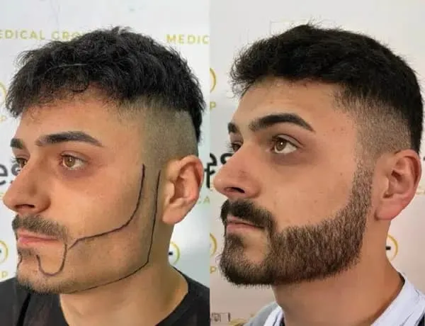 Beard Transplant Manchester for Fuller and Natural Looking Beard Growth