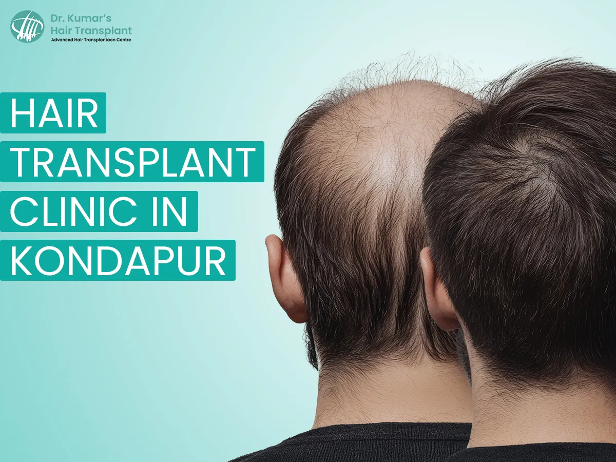 Everything You Should Know Before Getting a Hair Transplant in Kondapur