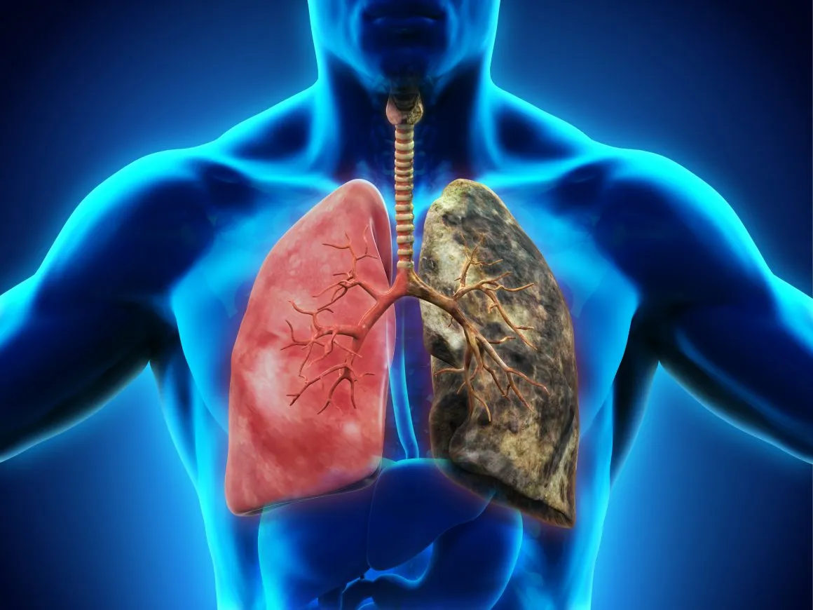 Small Cell Lung Cancer Treatment: What Happens After Diagnosis?