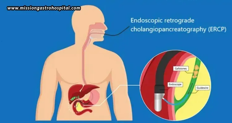 ERCP For Jaundice – Is It Helpful?