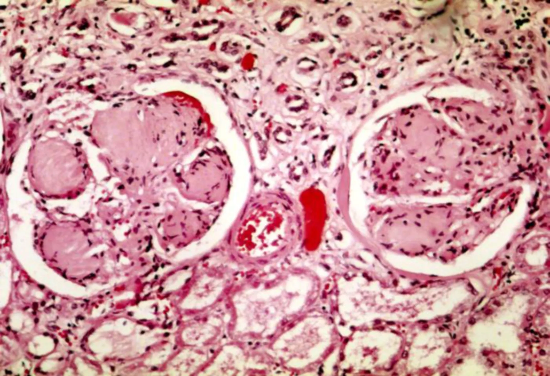 IgM Symptoms: Understanding the Signs of IgM Nephropathy