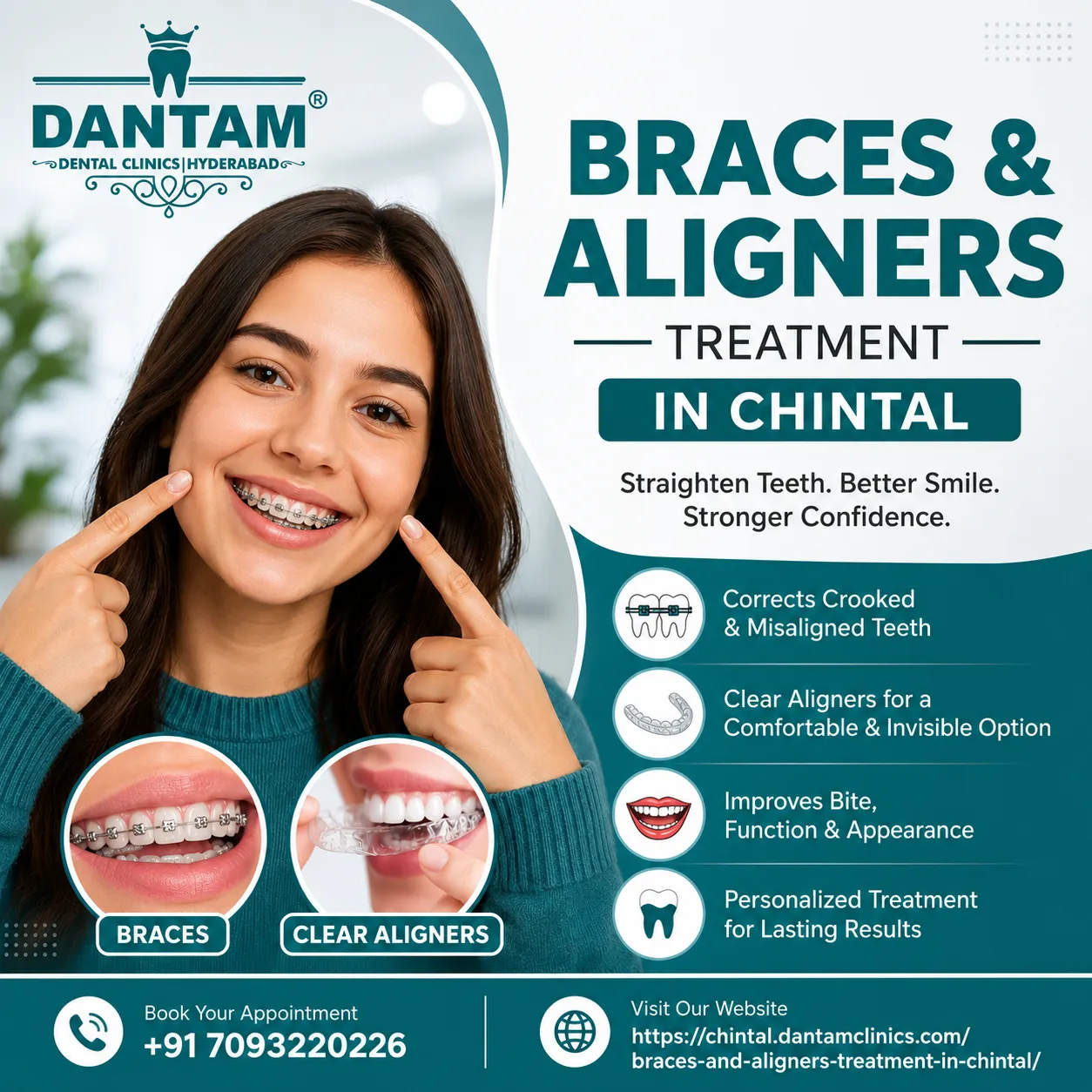 Braces and Aligners in Chintal: Modern Orthodontic Treatment for a Better Smile