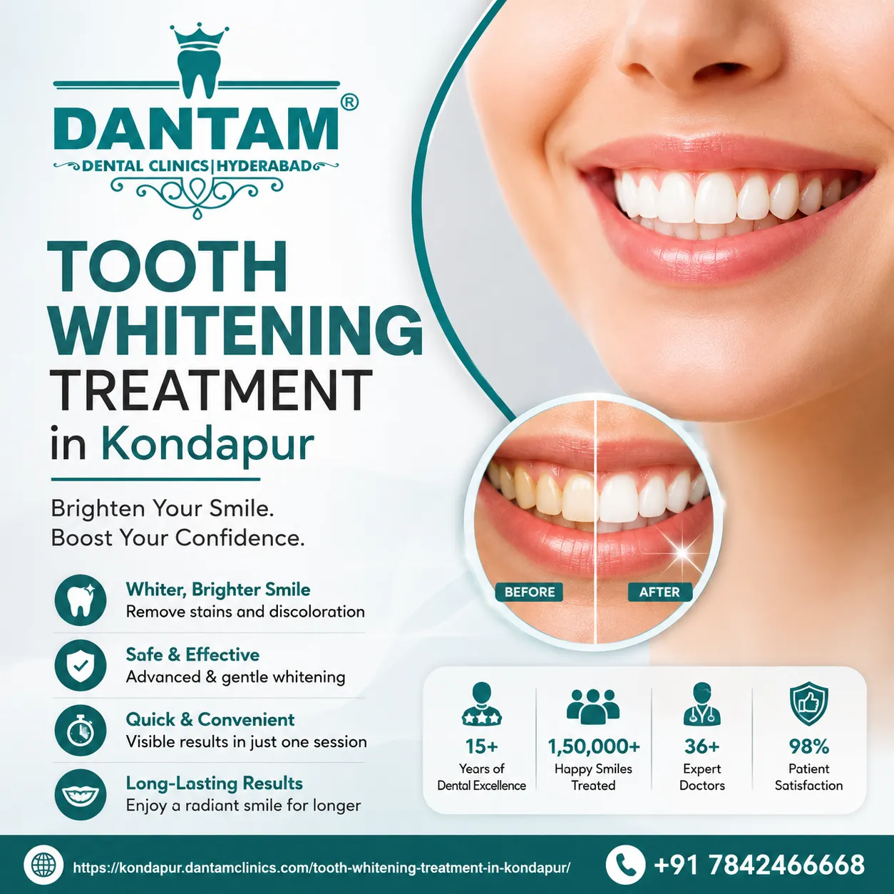 Teeth Whitening in Kondapur: A Complete Guide to a Brighter Smile