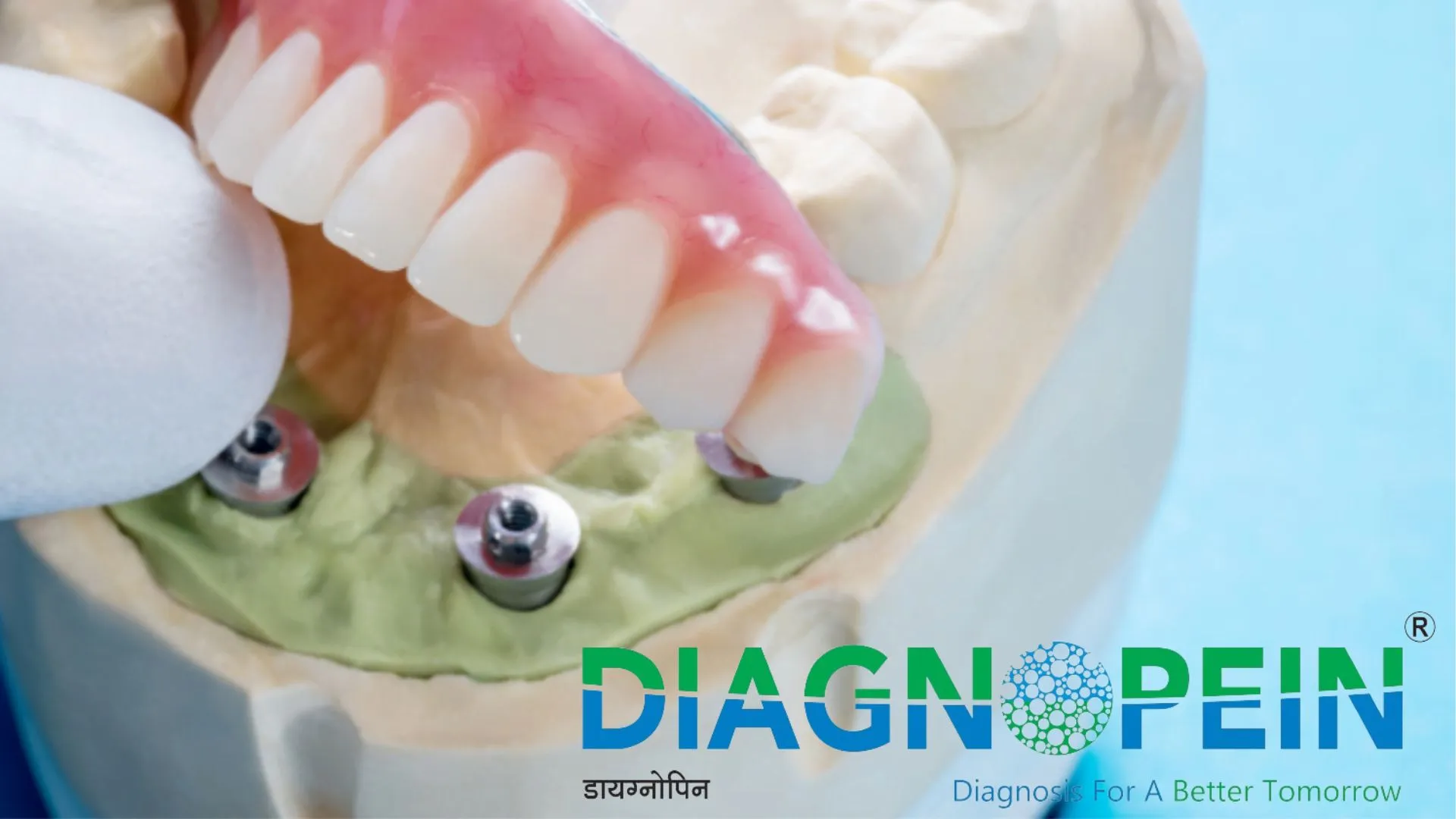 Find Quality Dental Bridges Near Me for a Better Smile