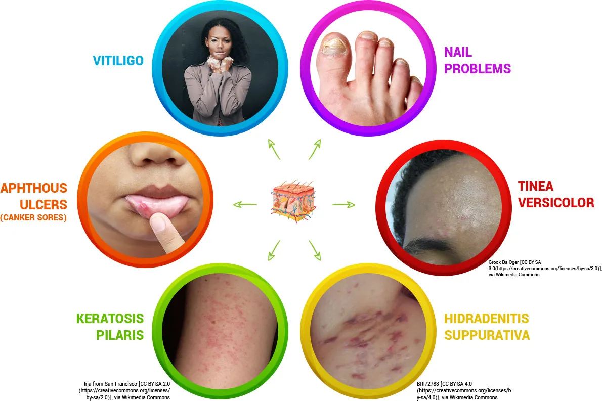 How a Naturopathic Doctor Can Help Treat Acne