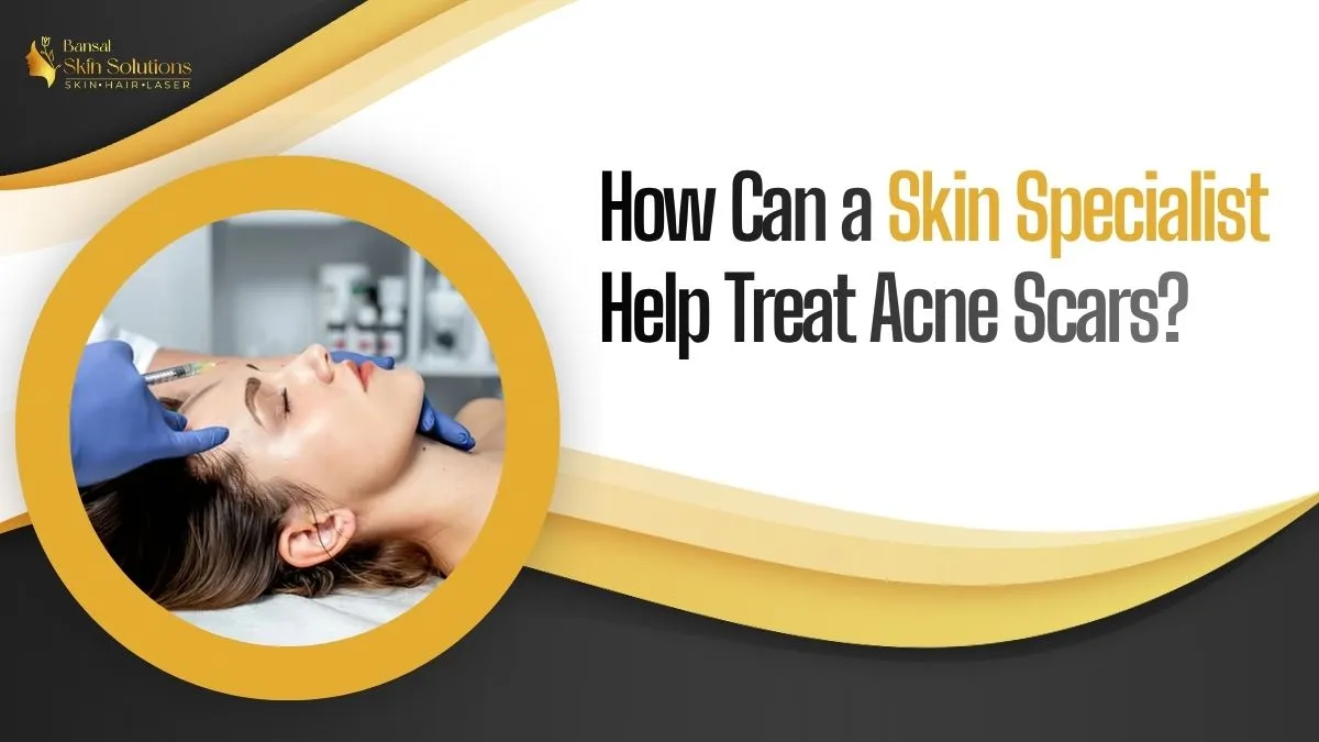 How Can a Skin Specialist Help Treat Acne Scars?