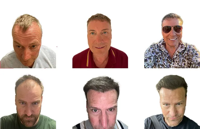 Hair Loss Treatment for Men: Options for Receding Hairlines and Bald Spots