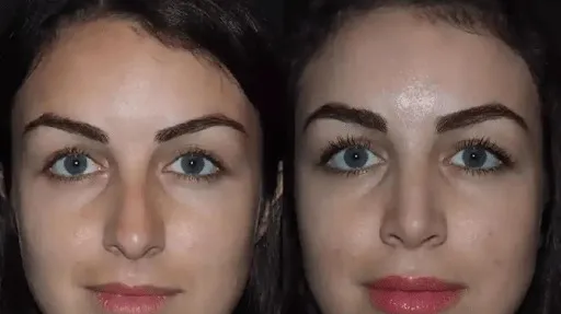 Rhinoplasty in Dubai: How 3D Imaging Can Help With Planning