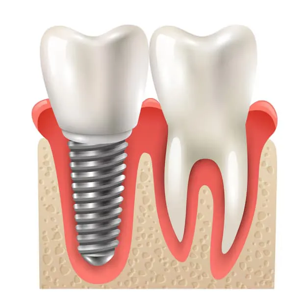 Single Tooth Implant for a Natural Looking Smile