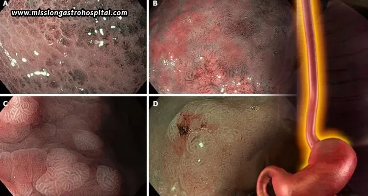 How NBI Endoscopy Improves Digestive Tract Abnormality Detection