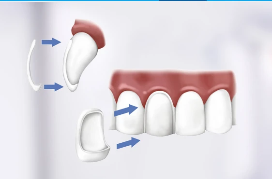 Global Dental Veneers Market is anticipated to create a value opportunity of around USD 4.7 billion by 2032 – Dentsply International, Zimmer, PHILIPS, DenMat