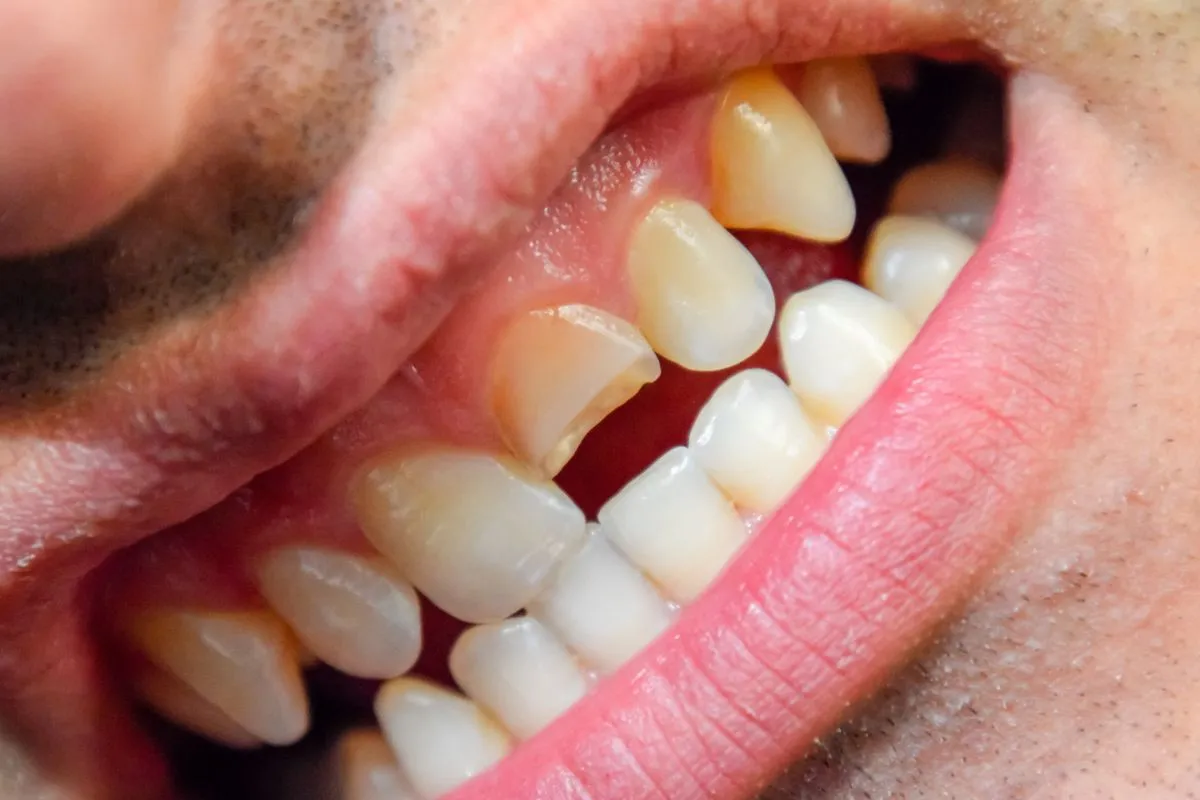 What Not to Do After Cracking a Tooth (Common Mistakes to Avoid)