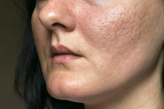 Unveiling Radiant Skin: Pros and Cons of Chemical Peels for Acne Scars