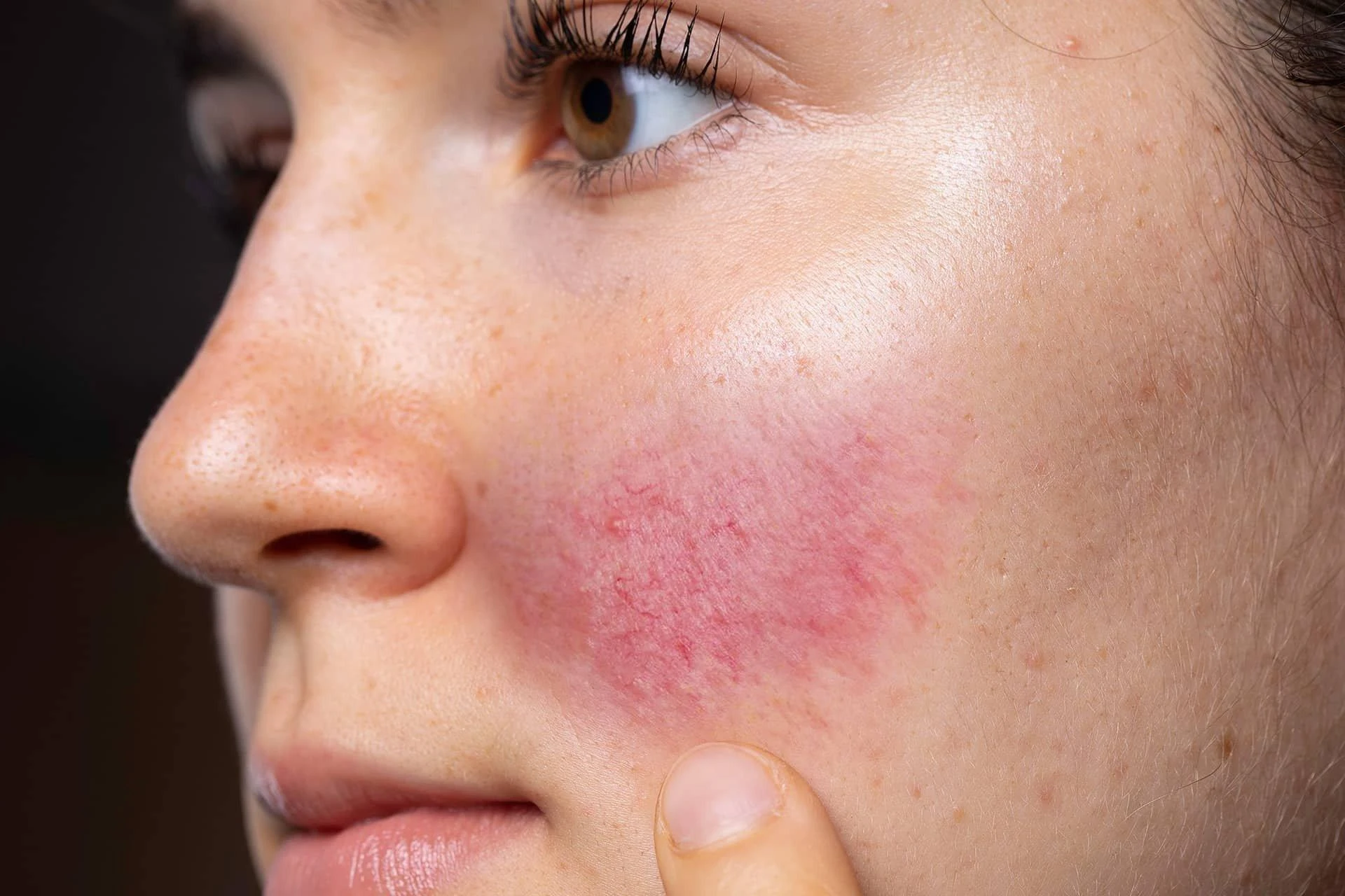 Dietary Considerations for Rosacea Sufferers