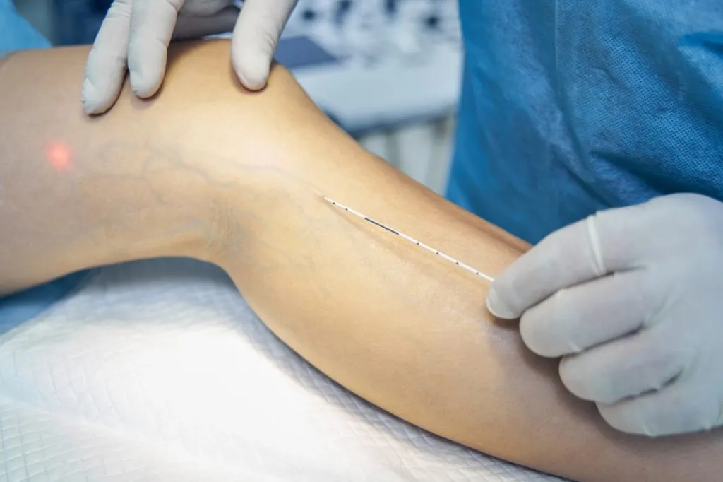 Are Your Varicose Veins Getting Worse? A Mumbai Vein Specialist Explains When to Act