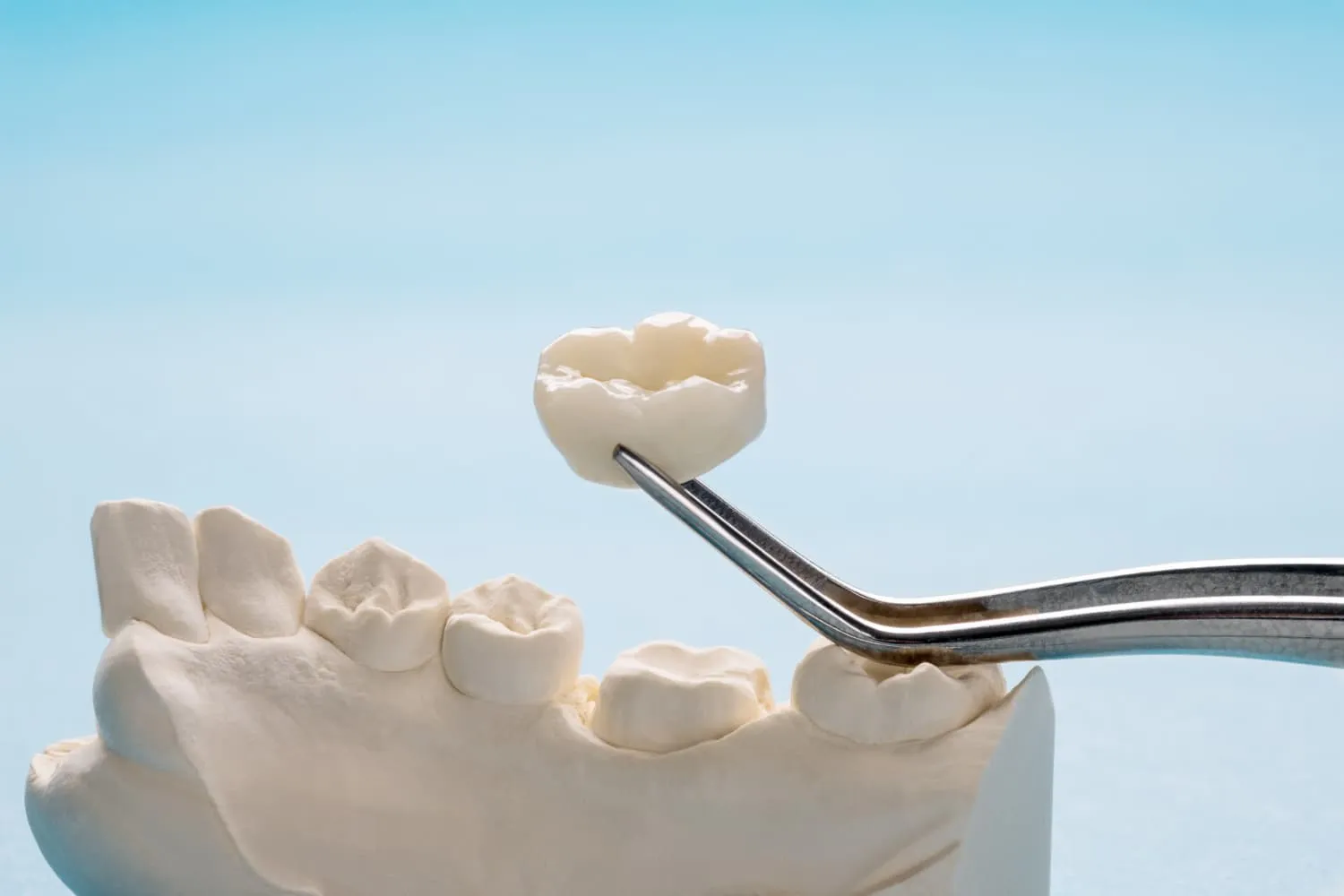 Restore Damaged Teeth Effectively With a Dental Crown in Cardiff