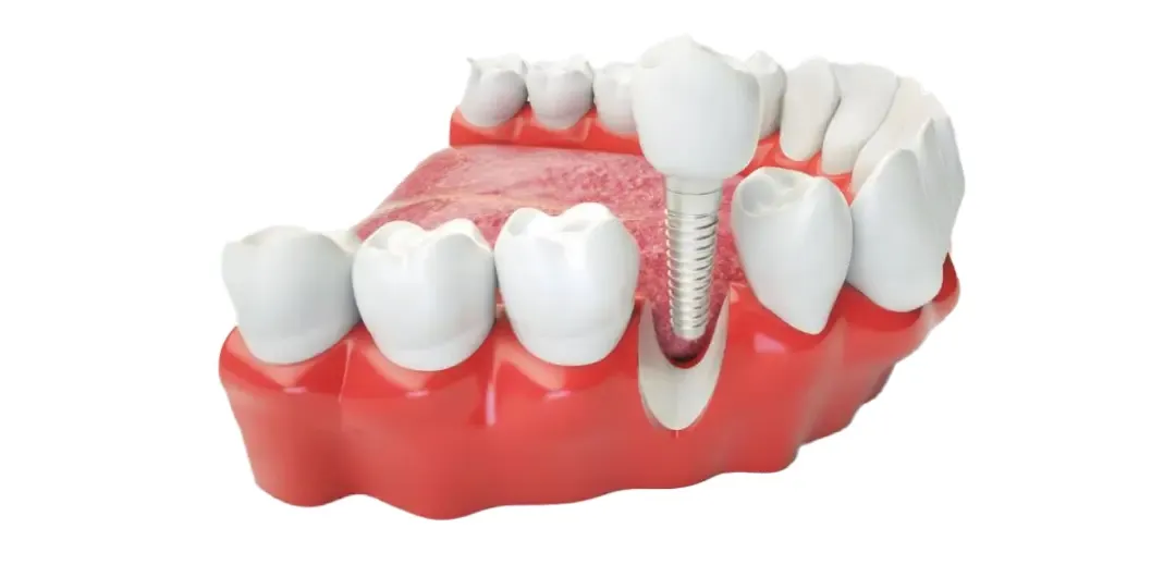 What Makes a Great Dental Implant Dentist in Perth?