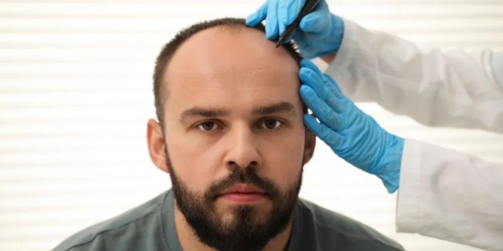 Hair Transplant Recovery: Day-by-Day and Month-by-Month Guide
