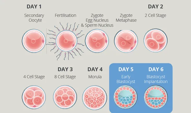 Blastocyst Transfer IVF Zirakpur: Understanding the IVF Transfer Process