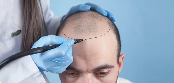 Best Hair Transplant in Turkey for Afro Hair: Expert Solutions for Natural Results