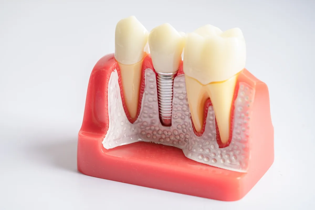 How to Choose the Right Dentist Woodbridge for Dental Implants