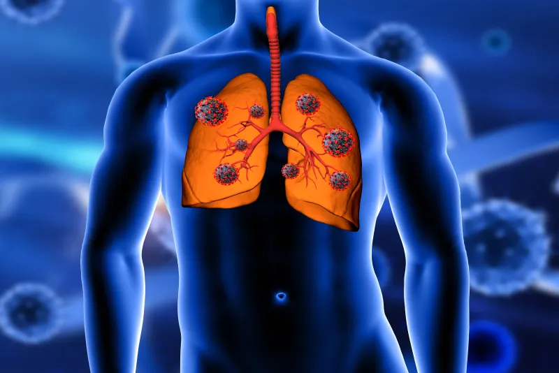 Lung Cancer Symptoms: Early Signs, Risk Factors, Diagnosis and Treatment Cost