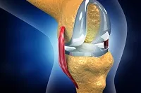 Common Myths About Joint Replacement Surgery You Should Stop Believing