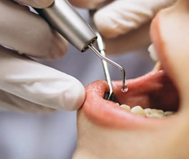 Sudden Tooth Pain? Trust Katy Lakes Dentistry for Gentle Emergency Tooth Extraction & Family Dental Care!