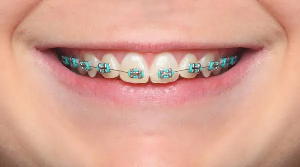 Smiles Made Simple: Expert Orthodontic & Pediatric Care at Shark Orthodontics and Pediatric Dentistry