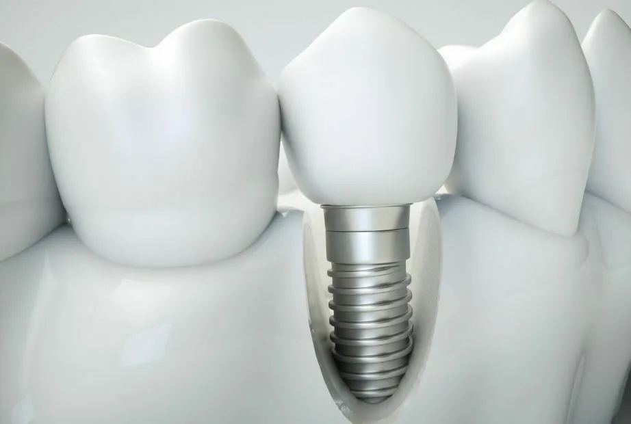 Implantes dentales en Pozuelo: precio, calidad y cuidados esenciales