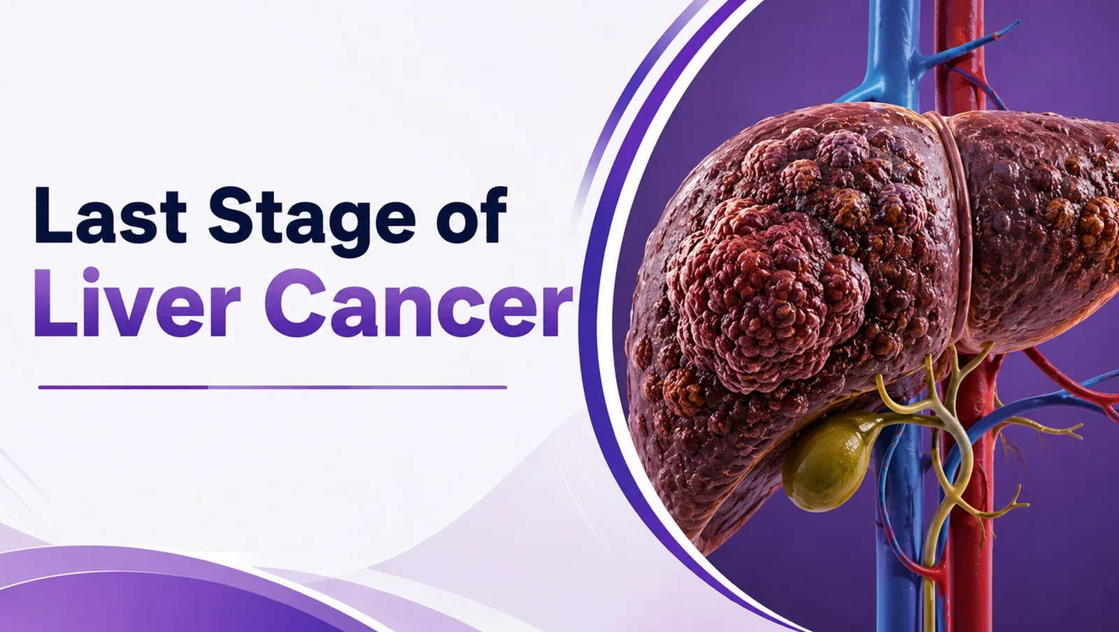What Is the Last Stage of Liver Cancer?