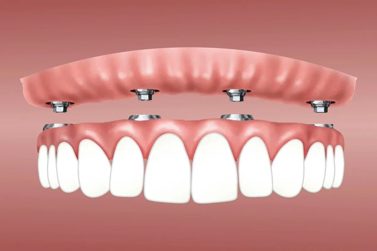 What Are Full Mouth Implants, and How Much Do They Cost?