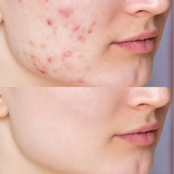 Looking for Affordable Acne Scar Treatment in Christchurch?
