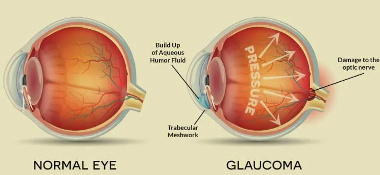 Find the Best Glaucoma Specialist in Kolkata for Expert Care