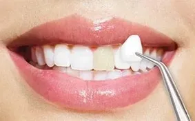 Affordable Dentures or Veneers? Comparing Smile Restoration Options