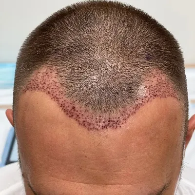 Which Hair Transplant Technique Is Best for Your Hair Loss in Dubai?