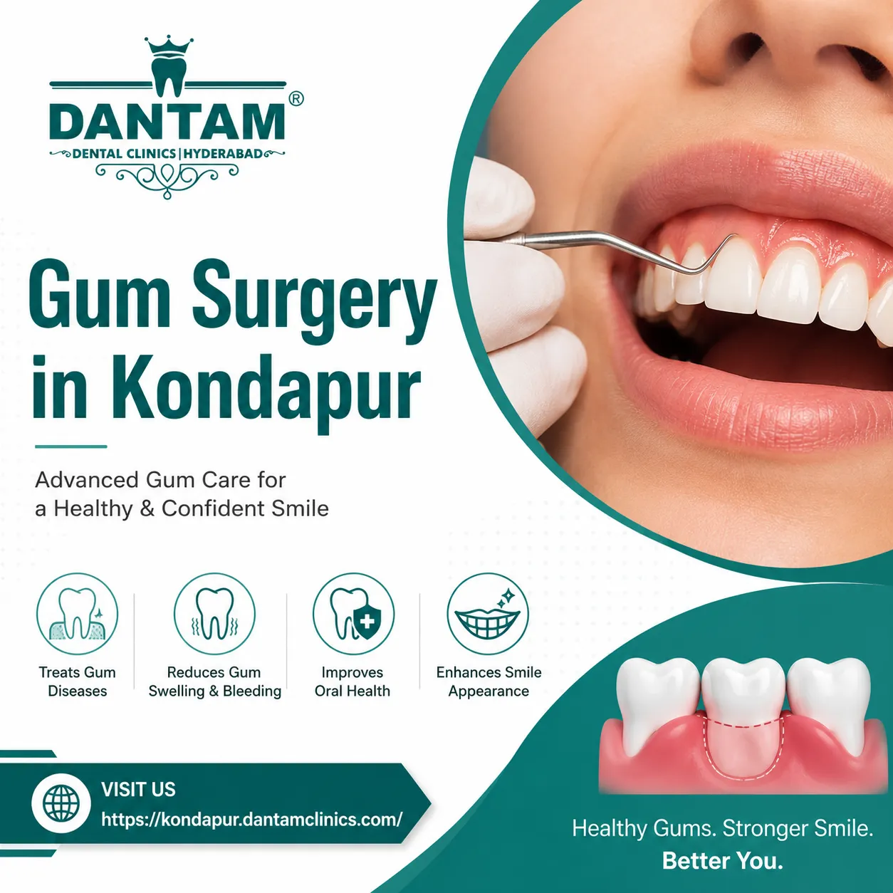 Gum Surgery in Kondapur – Complete Guide to Gum Care