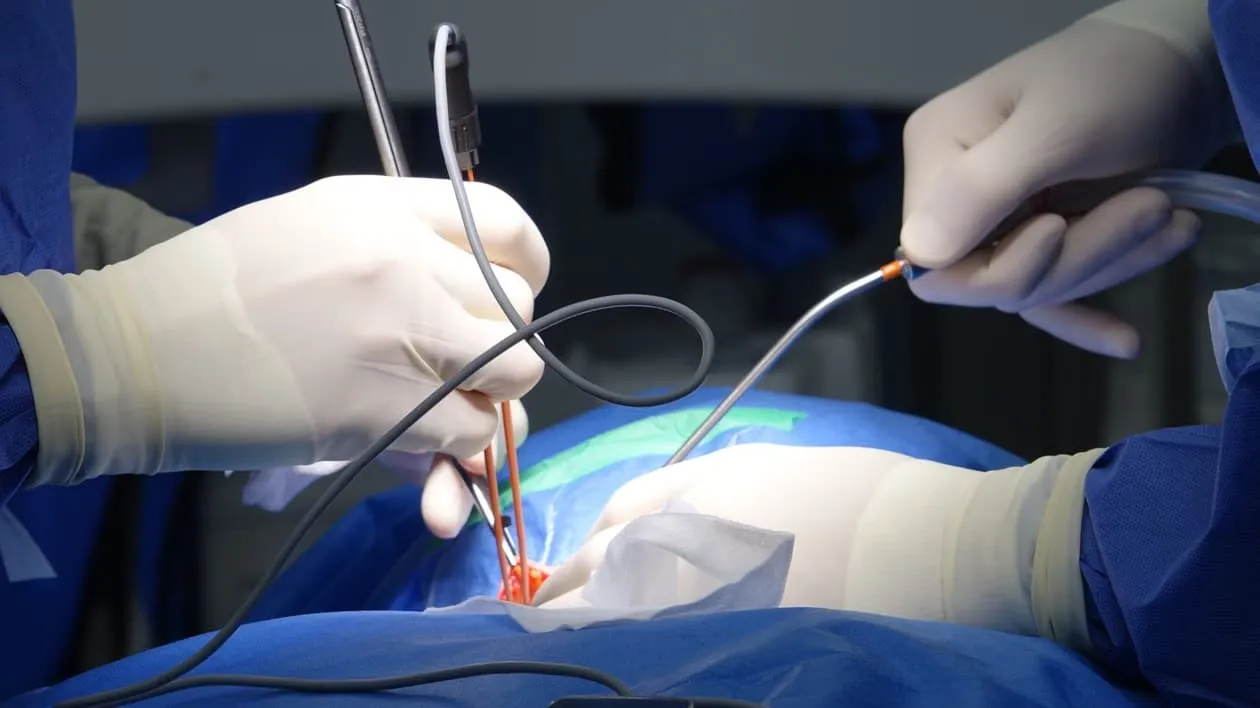 What to Expect Before and After Laser Stone Surgery in Surat?