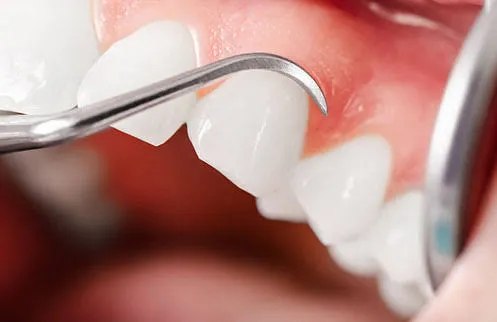 Gum Treatment in Dubai
