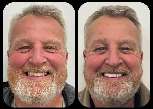 How Do Functional Jaw Repositioning and Mandibular Advancement Address a Receding Lower Jaw?