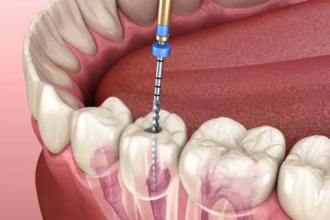 Root Canal Treatment in Dubai