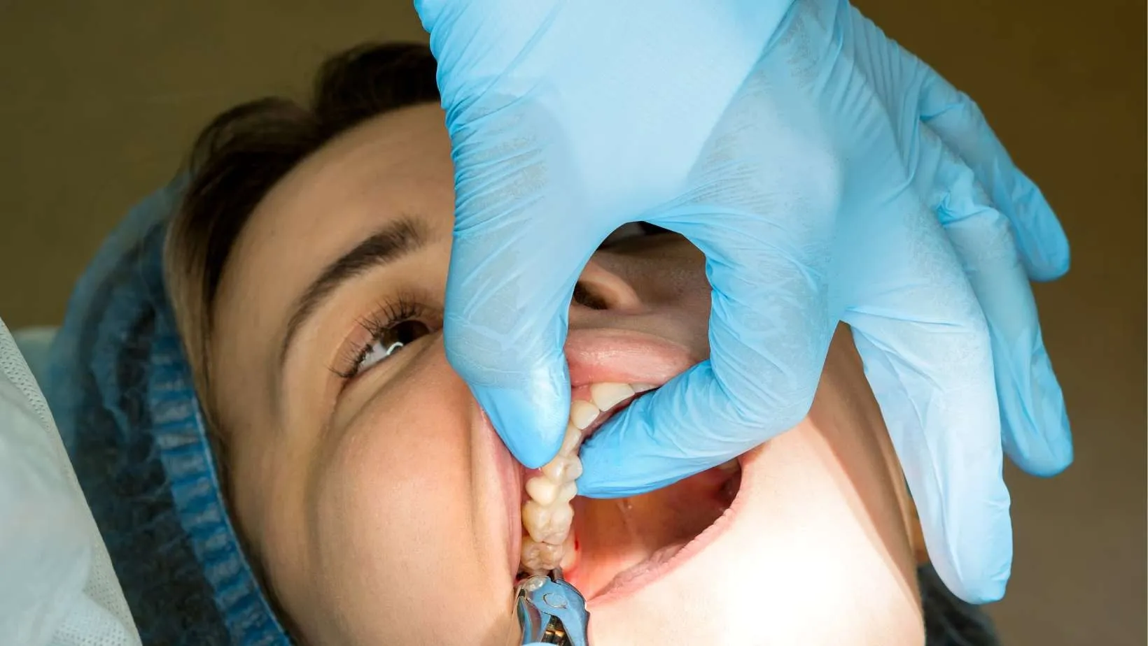 Can Delaying Wisdom Tooth Care Damage Nearby Healthy Teeth?
