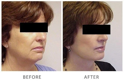 5 Advantages of Facelift Surgery
