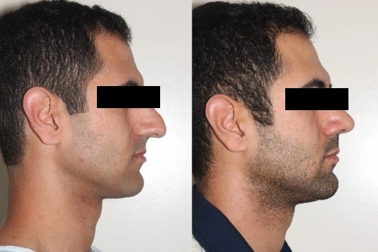 Rhinoplasty Surgery in Delhi to Intensify Your Facial Look