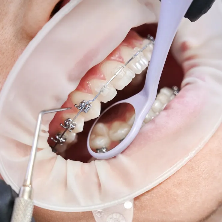 Your Complete Guide to Invisalign and Pittsburgh Orthodontics