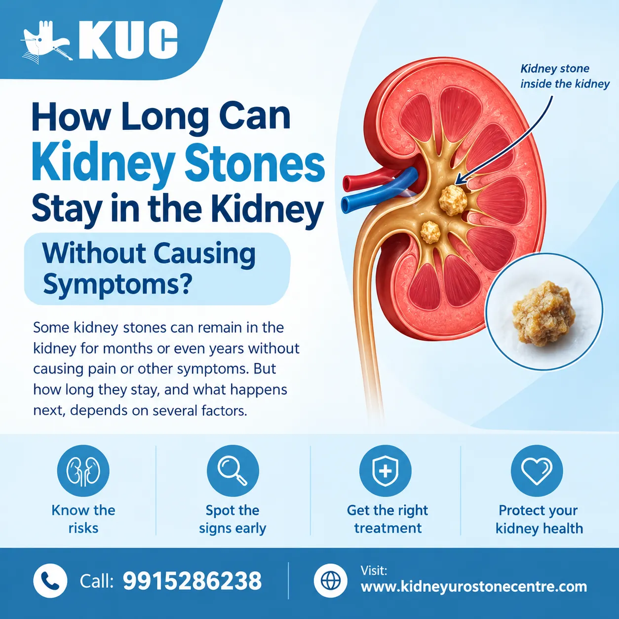 How Long Can Kidney Stones Stay in the Kidney Without Causing Symptoms?
