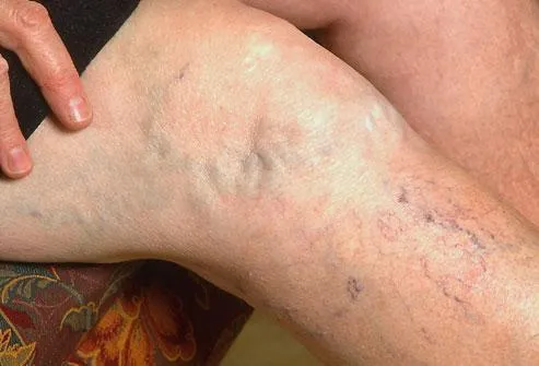 Can Dehydration Make Varicose Vein Symptoms Worse?